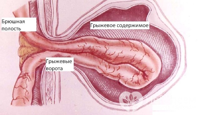 Паховая грыжа: симптомы, причины и варианты лечения