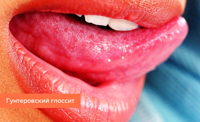 Глоссит что это такое, симптомы и лечение
