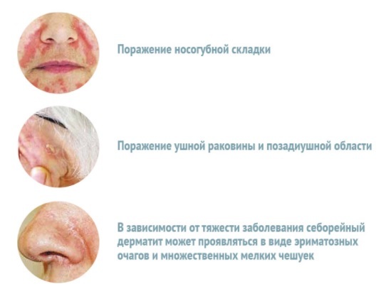 Как лечить себорейный дерматит на лице в домашних условиях