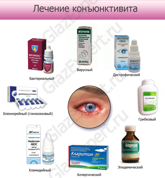 Аллергический конъюнктивит у взрослых: симптомы и лечение