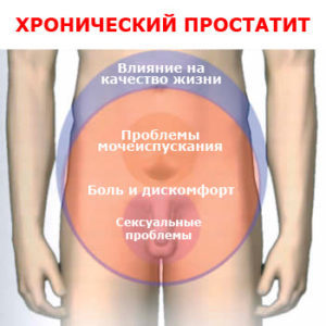 Аденома предстательной железы: симптомы, лечение и прогноз