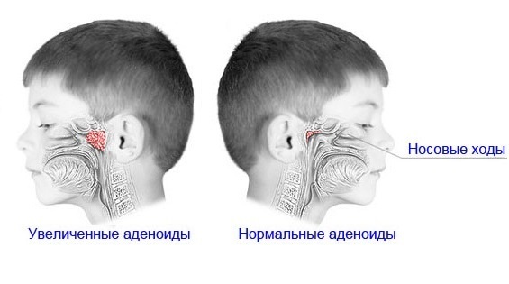 Аденоидит у детей: фото, симптомы и рекомендации по лечению