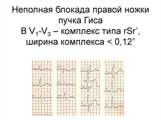 Блокада ножек пучка гиса: что это такое, чем опасно такое состояние?