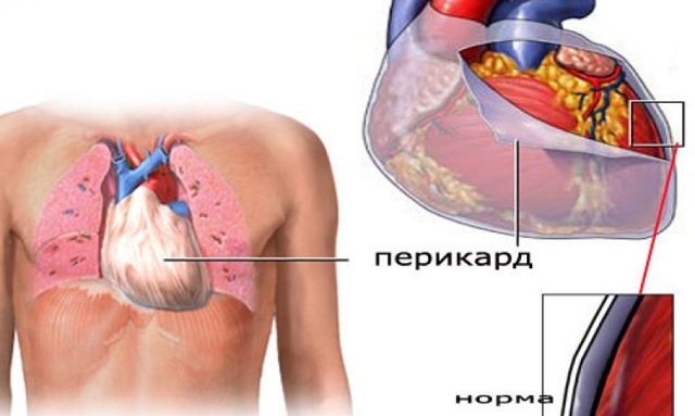 Перикардит, что это такое? Причины и способы лечения