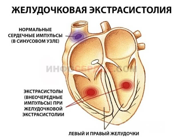 Желудочковая экстрасистолия, что это такое? Лечение и последствия