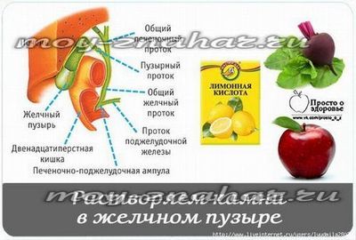 Симптомы камней в желчном пузыре, лечение и правильная диета