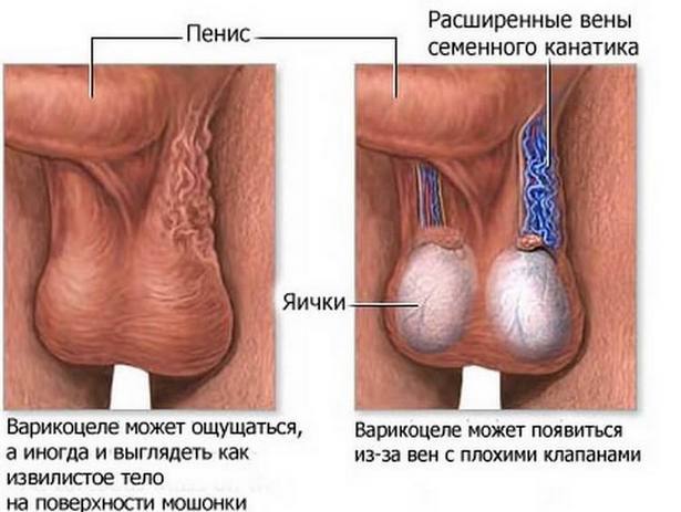 Азооспермия что это такое: причины, лечение, отзывы мужчин