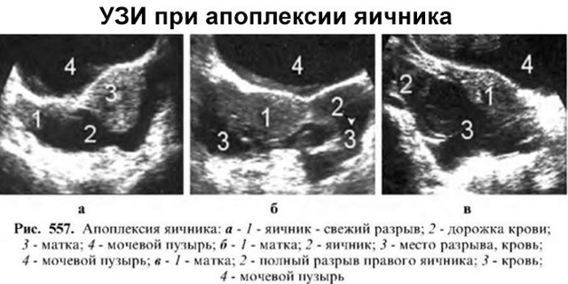 Апоплексия яичника: первые симптомы, причины и варианты лечения