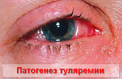 Туляремия, что это такое? Симптомы и лечение у человека