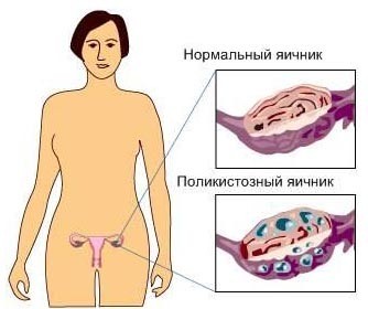 Поликистоз яичников, что это такое? Симптомы и лечение