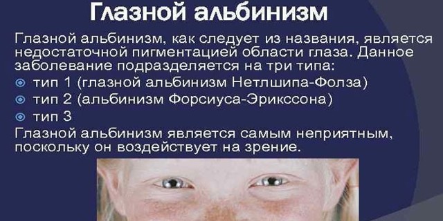 Альбинизм у человека: признаки, причины и лечение