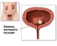 Как лечить камни в мочевом пузыре