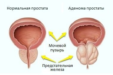Аденома предстательной железы: симптомы, лечение и прогноз