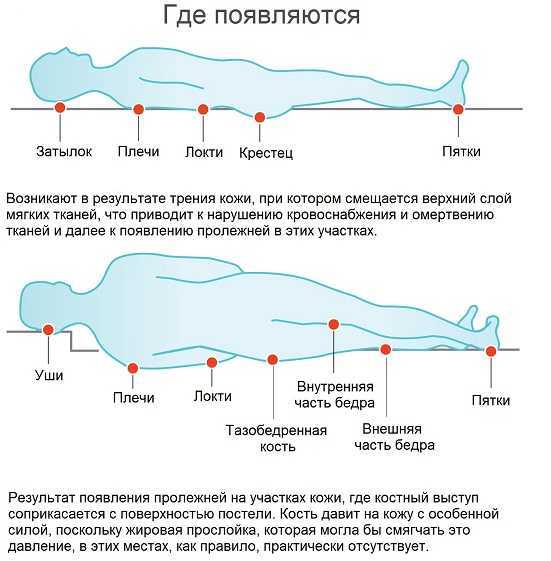 Пролежни у лежачих больных: лечение и профилактика, фото в начальной стадии
