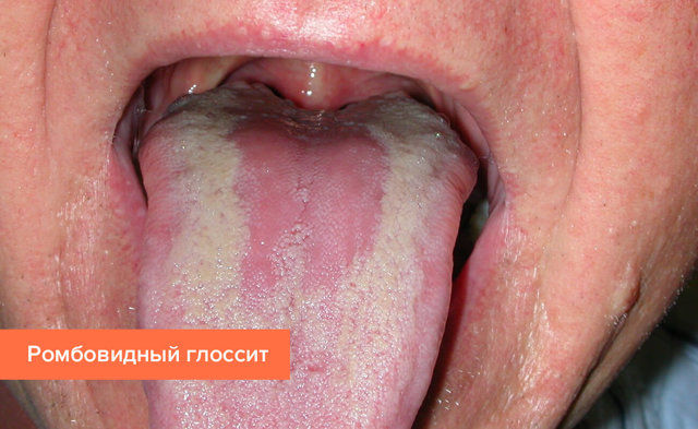 Глоссит что это такое, симптомы и лечение