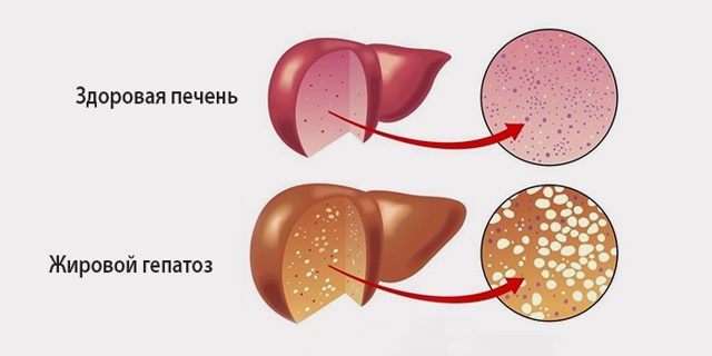 Что такое жировой гепатоз и чем лечить печень?