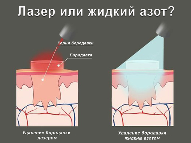 Подошвенная бородавка: симптомы, фото, способы удаление бородавок