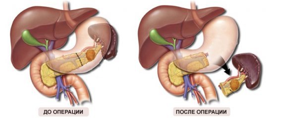Киста поджелудочной железы: симптомы, причины и лечение