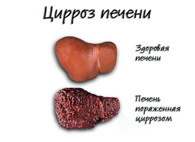 Признаки цирроза печени