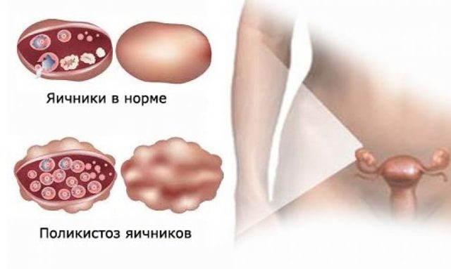Поликистоз яичников, что это такое? Симптомы и лечение