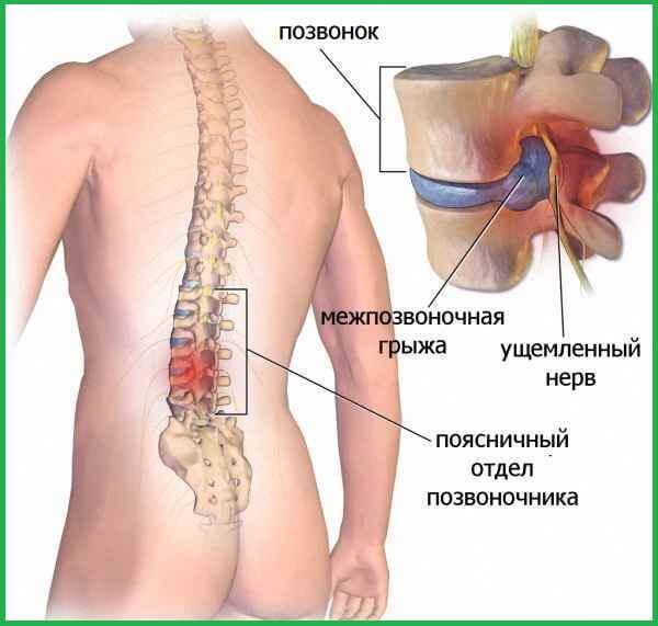 Грыжа поясничного отдела позвоночника: симптомы и лечение