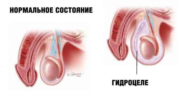 Водянка яичка: симптомы и лечение, отзывы мужчин