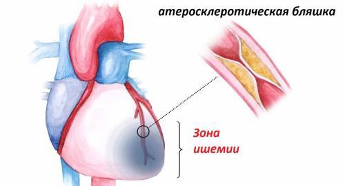 Что такое ишемическая болезнь сердца и чем ее лечить?