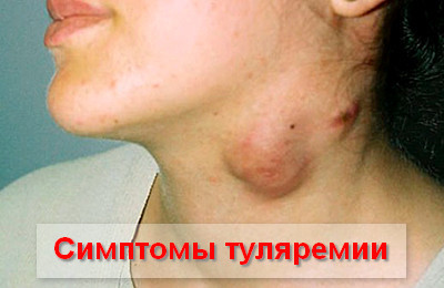 Туляремия, что это такое? Симптомы и лечение у человека