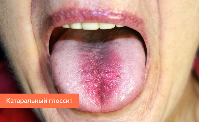 Глоссит что это такое, симптомы и лечение