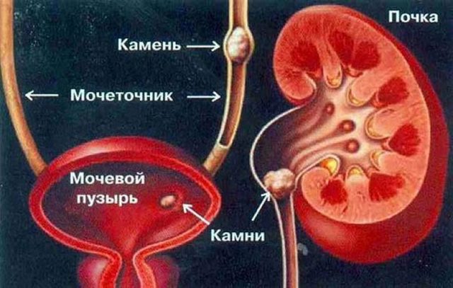 Мочекаменная болезнь: симптомы и способы лечения в домашних условиях