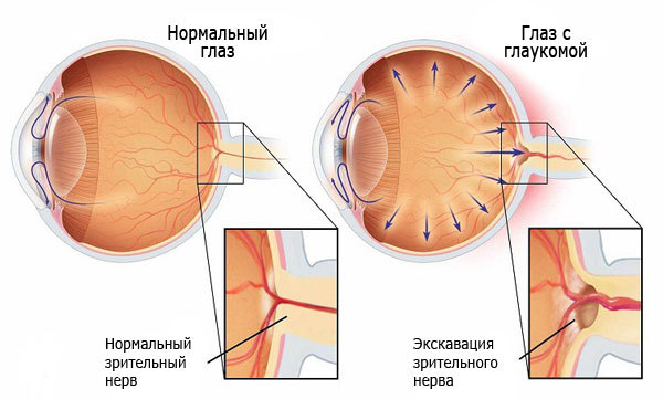 Симптомы глаукомы, лечение и профилактика