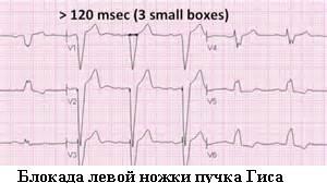 Блокада ножек пучка гиса: что это такое, чем опасно такое состояние?
