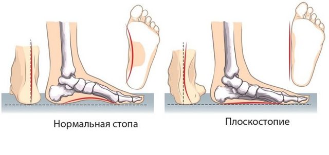 Артроз голеностопного сустава: симптомы и схема лечения
