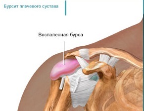 Как выглядит бурсит плечевого сустава, его первые симптомы и варианты лечения