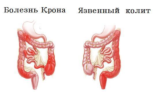 Сигмоидит, что это такое? Симптомы и лечение