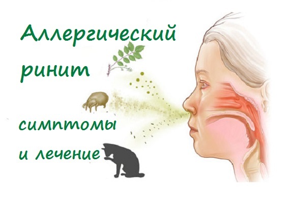 Аллергический ринит: симптомы, лечение и профилактика