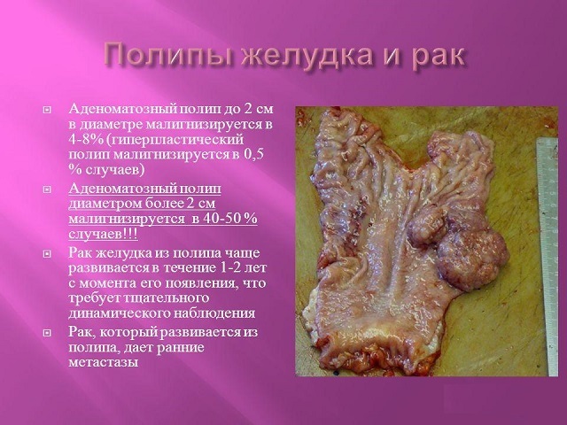 Полип в желудке – это опасно или нет? Симптомы и удаление полипов