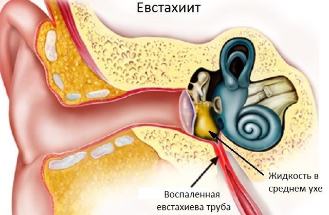 Евстахиит: что это такое? Симптомы и способы лечения