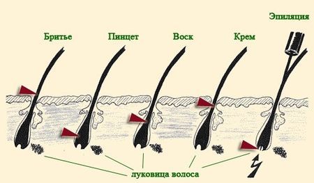 Вросший волос в области бикини, на ногах: как избавиться в домашних условиях